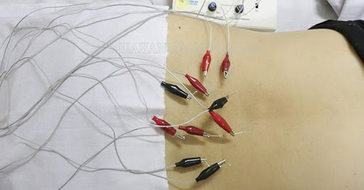 Phương pháp điện châm sử dụng dòng điện để chữa bệnh