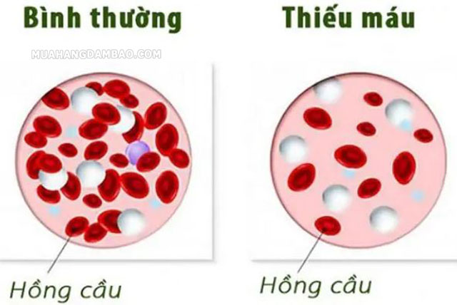 Tình trạng chỉ số RBC thấp là biểu hiện của thiếu máu