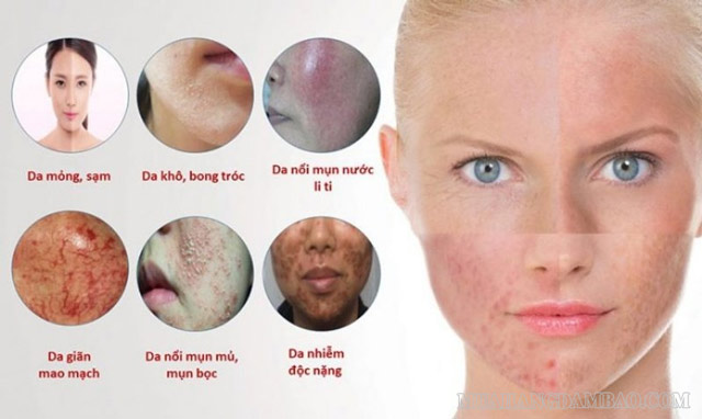 Da bị nhiễm corticoid sẽ rất khó để hồi phục