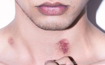 Dấu hickey có thể gây ra một số tác hại nhất định nếu không làm đúng cách