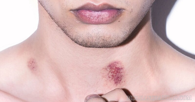 Dấu hickey có thể gây ra một số tác hại nhất định nếu không làm đúng cách