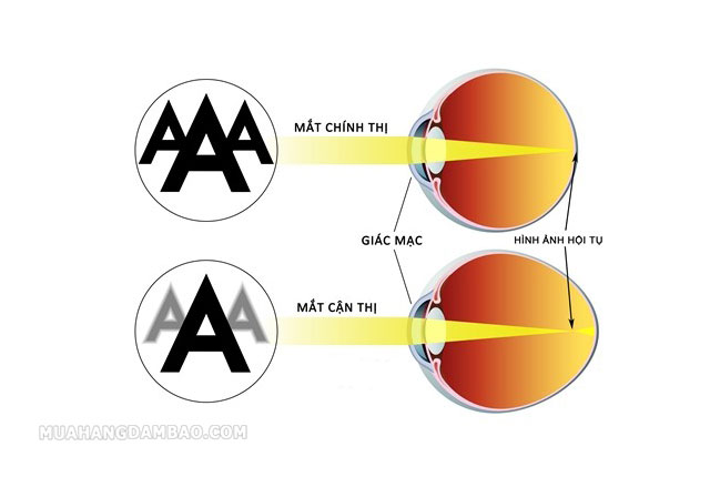 Người cận thị có hình ảnh hội tụ ở trước võng mạc