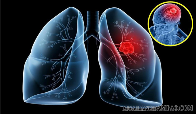 Xét nghiệm NSE giúp  theo dõi quá trình điều trị bệnh ung thư phổi tế bào nhỏ