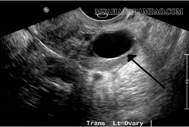 Hình ảnh cho thấy 1 khối echo trống trong cơ thể khi siêu âm