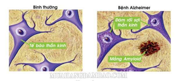 Các mảng amyloid ngăn việc não gửi và truyền đi tín hiệu